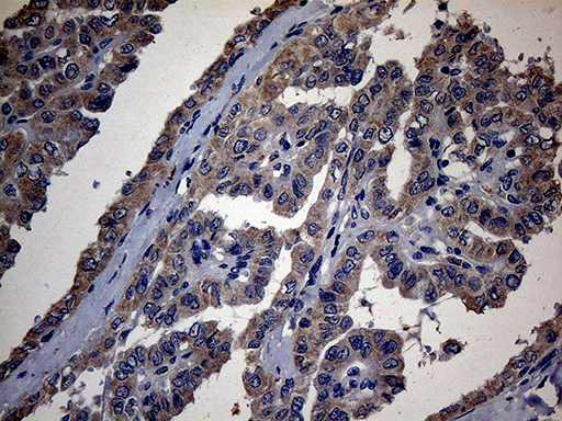 Immunohistochemical staining of paraffin-embedded Carcinoma of Human thyroid tissue using anti-PON3 mouse monoclonal antibody