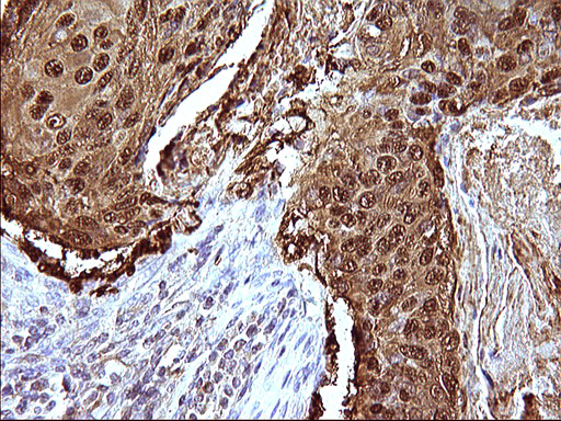 Immunohistochemical staining of paraffin-embedded Carcinoma of Human lung tissue using anti-SERPINB3 mouse monoclonal antibody
