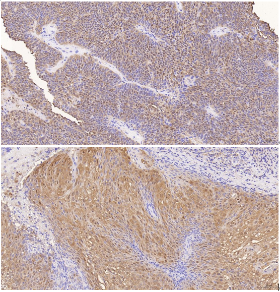  IHC analysis of SerpinB3 using anti-SerpinB3 antibody (M04067-2)