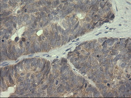 Immunohistochemical staining of paraffin-embedded Adenocarcinoma of Human ovary tissue using anti-SERPINB3 mouse monoclonal antibody