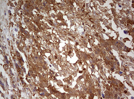 Immunohistochemical staining of paraffin-embedded Adenocarcinoma of Human ovary tissue using anti-ARL3 mouse monoclonal antibody
