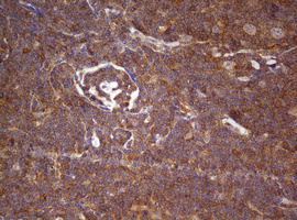Immunohistochemical staining of paraffin-embedded Human lymphoma tissue using anti-ARL3 mouse monoclonal antibody