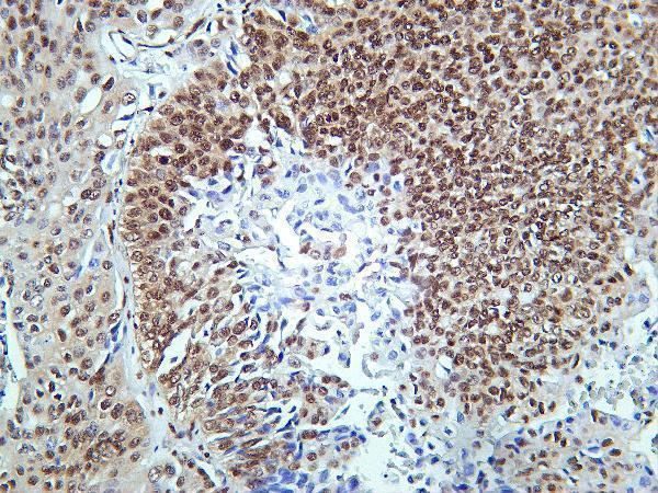 Human bladder carcinoma was stained with Anti-CIRBP rabbit antibody