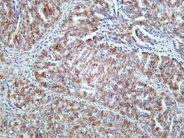 Human colon carcinoma was stained with Anti-CIRBP rabbit antibody