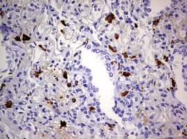 Immunohistochemical staining of paraffin-embedded Carcinoma of Human lung tissue using anti-TGIF1 mouse monoclonal antibody