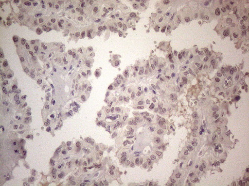 Immunohistochemical staining of paraffin-embedded Carcinoma of Human thyroid tissue using anti-ERCC8 mouse monoclonal antibody