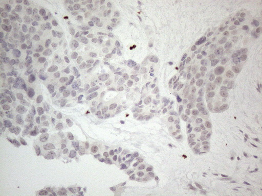 Immunohistochemical staining of paraffin-embedded Adenocarcinoma of Human endometrium tissue using anti-ERCC8 mouse monoclonal antibody