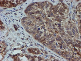 Immunohistochemical staining of paraffin-embedded Adenocarcinoma of Human ovary tissue using anti-SAT2 mouse monoclonal antibody