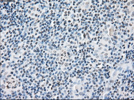 Immunohistochemical staining of paraffin-embedded Carcinoma of thyroid tissue using anti-FKBP5mouse monoclonal antibody