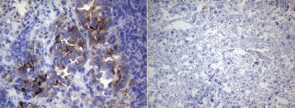 Immunohistochemical staining of paraffin-embedded HCC78 (left) and HeLa (right) xenograft using M04186 (0