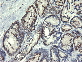 Immunohistochemical staining of paraffin-embedded Carcinoma of Human thyroid tissue using anti-TRIM22 mouse monoclonal antibody
