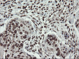 Immunohistochemical staining of paraffin-embedded Carcinoma of Human lung tissue using anti-CHN1 mouse monoclonal antibody