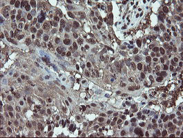 Immunohistochemical staining of paraffin-embedded Carcinoma of Human lung tissue using anti-RYBP mouse monoclonal antibody