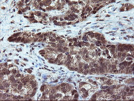 Immunohistochemical staining of paraffin-embedded Adenocarcinoma of Human ovary tissue using anti-RYBP mouse monoclonal antibody
