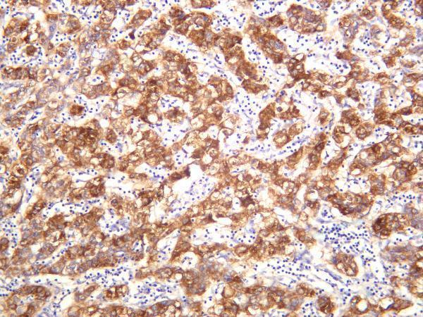 Human hepatocellular carcinoma was stained with anti-ACSL4 rabbit antibody
