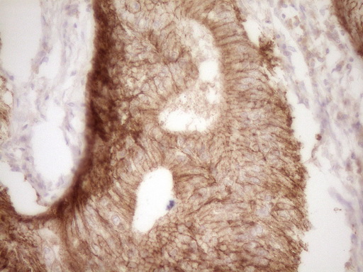 Immunohistochemical staining of paraffin-embedded Adenocarcinoma of Human colon tissue using anti-CLDN3 mouse monoclonal antibody