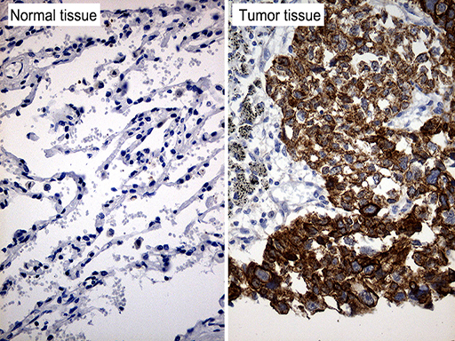 Immunohistochemical staining of paraffin-embedded Carcinoma of Human lung tissue using anti-TRIM29 mouse monoclonal antibody