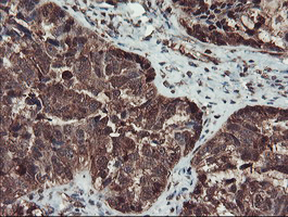 Immunohistochemical staining of paraffin-embedded Adenocarcinoma of Human ovary tissue using anti-SERPINB1 mouse monoclonal antibody