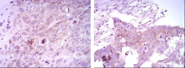 Immunohistochemistry analysis of paraffin-embedded lung cancer tissues (left) and ovarian cancer tissues (right) with DAB staining using FoxD3 Monoclonal Antibody