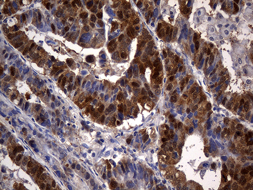 Immunohistochemical staining of paraffin-embedded Human Gastric Carcinoma using anti-CSE1L mouse monoclonal antibody