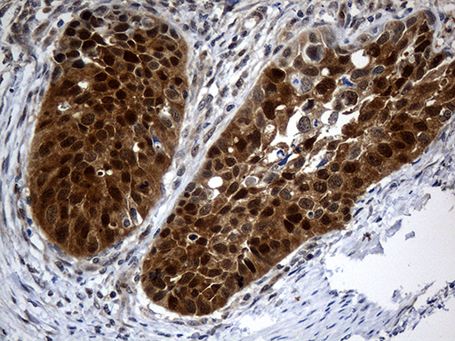 Immunohistochemical staining of paraffin-embedded Carcinoma of Human kidney tissue using anti-CSE1L mouse monoclonal antibody