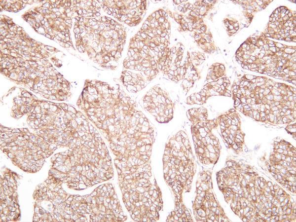 Humanhepatocellularcarcinoma was stained with anti-Flotillin-1 rabbit antibody