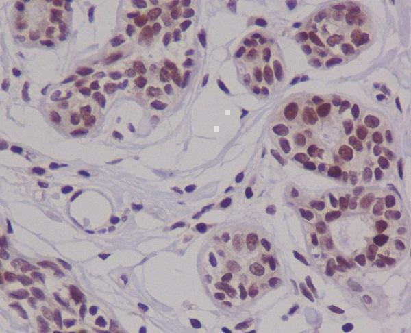 Immunohistochemical analysis of paraffin-embedded human breast carcinoma, using Cyclin E2 Antibody