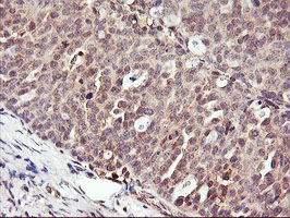 Immunohistochemical staining of paraffin-embedded Adenocarcinoma of Human ovary tissue using anti-DPP9 mouse monoclonal antibody