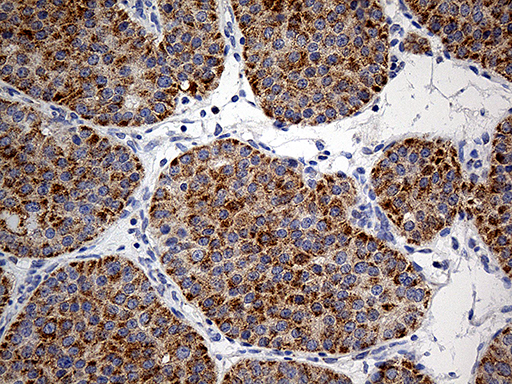 Immunohistochemical staining of paraffin-embedded Carcinoma of Human pancreas tissue using anti-COX17 mouse monoclonal antibody