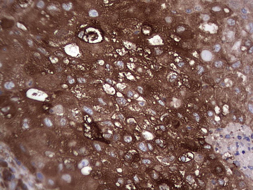 Immunohistochemical staining of paraffin-embedded Carcinoma of Human lung tissue using anti-GARS mouse monoclonal antibody