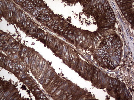 Immunohistochemical staining of paraffin-embedded Adenocarcinoma of Human colon tissue using anti-GARS mouse monoclonal antibody
