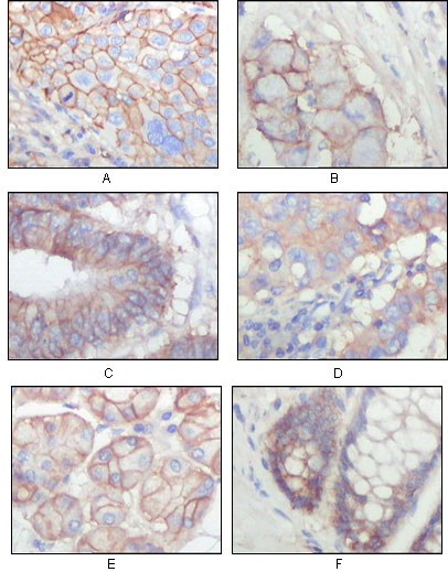 Immunohistochemistry analysis of paraffin-embedded human lung squamous cell carcinoma (A), lung adenocarcinoma (B), colon carcinoma (C), breast carcinoma (D), normal sublingual gland (E), normal rectal (F), showing membrane localization with DAB staining