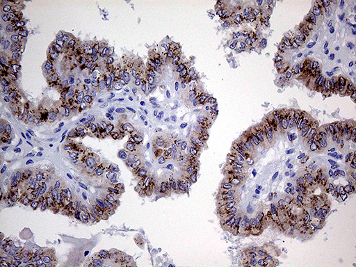 Immunohistochemical staining of paraffin-embedded Carcinoma of Human thyroid tissue using anti-MYOT mouse monoclonal antibody