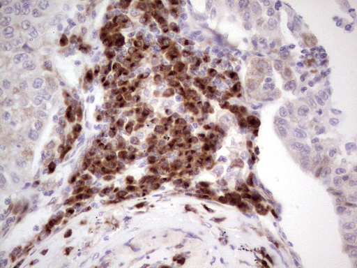 Immunohistochemical staining of paraffin-embedded Carcinoma of Human lung tissue using anti-BHLHE41 mouse monoclonal antibody