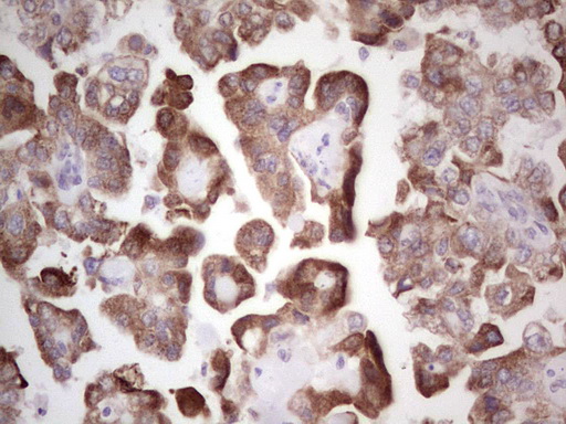 Immunohistochemical staining of paraffin-embedded Adenocarcinoma of Human ovary tissue using anti-BHLHE41 mouse monoclonal antibody