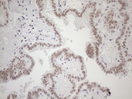 Immunohistochemical staining of paraffin-embedded Carcinoma of Human thyroid tissue using anti-HSF2 mouse monoclonal antibody