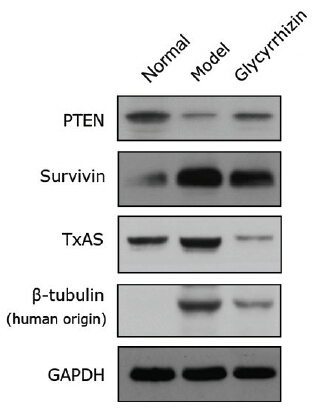 Figure from citation: Western Blot of TBXAS1 (TxAS) protein level by using anti-TBXAS1 antibody in human lung adenocarcinoma