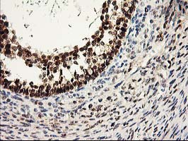 Immunohistochemical staining of paraffin-embedded Adenocarcinoma of Human ovary tissue using anti-PRMT2 mouse monoclonal antibody