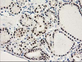 Immunohistochemical staining of paraffin-embedded Carcinoma of Human thyroid tissue using anti-PRMT2 mouse monoclonal antibody