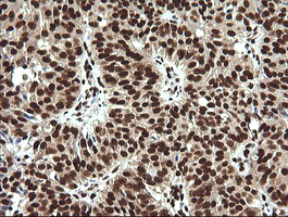 Immunohistochemical staining of paraffin-embedded Adenocarcinoma of Human ovary tissue using anti-SAE1 mouse monoclonal antibody