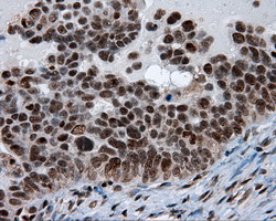 Immunohistochemical staining of paraffin-embedded Adenocarcinoma of ovary tissue using anti-SIL1 mouse monoclonal antibody