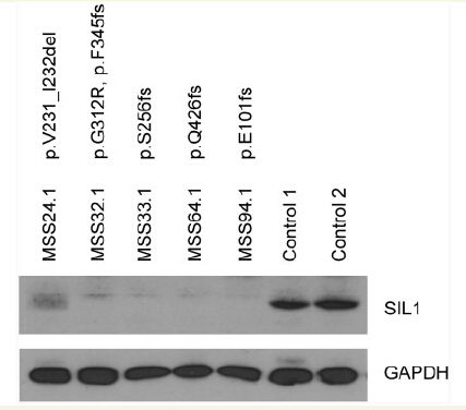 Figure from citation: Western Blot of SIL1 protein level by using anti-SIL1 antibody in immortalized lymphoblasts of patients with Marinesco-SjoÂ¨ gren syndrome