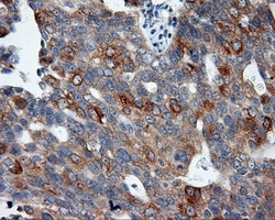 Immunohistochemical staining of paraffin-embedded Adenocarcinoma of ovary tissue using anti-SIL1 mouse monoclonal antibody