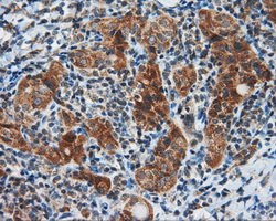 Immunohistochemical staining of paraffin-embedded Carcinoma of thyroid tissue using anti-SIL1 mouse monoclonal antibody