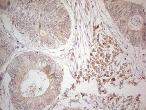 Immunohistochemical staining of paraffin-embedded Adenocarcinoma of Human colon tissue using anti-HR mouse monoclonal antibody