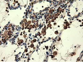 Immunohistochemical staining of paraffin-embedded Carcinoma of Human lung tissue using anti-MICAL1 mouse monoclonal antibody