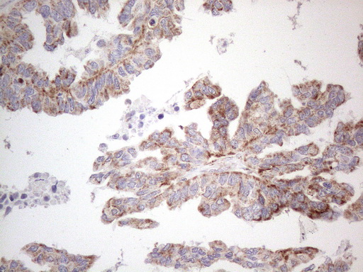 Immunohistochemical staining of paraffin-embedded Adenocarcinoma of Human ovary tissue using anti-DLX4 mouse monoclonal antibody