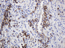 Immunohistochemical staining of paraffin-embedded Carcinoma of Human lung tissue using anti-RPN2 mouse monoclonal antibody