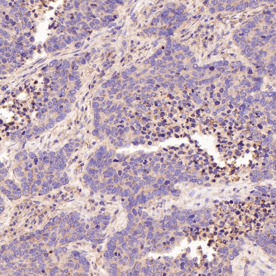 Immunohistochemical analysis of paraffin-embedded Human lung large cell cancer, using the Antibody at 1:50 dilution