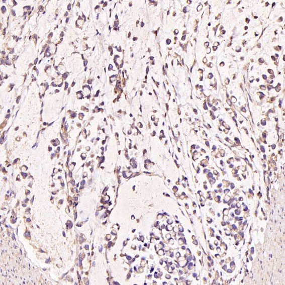 Immunohistochemical analysis of paraffin-embedded Human stomach cancer, using the Antibody at 1:50 dilution